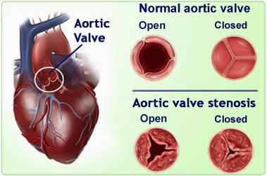 #thelancet #sténoseaortique #valvuleaortique #voietransfémorale Résultats à 5 ans d’un remplacement transcatheter d’une valvule aortique en comparaison d’un traitement standard chez des patients atteints de sténose aortique non opérable (PARTNER 1) : e...