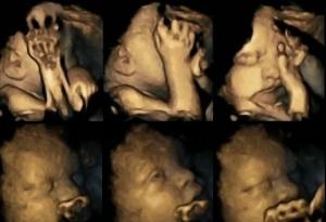 GROSSESSE et TABAGISME: Maman fume, bébé grimace – Acta Paediatrica