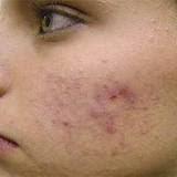 Recettes de rand-mère pour venir a bout des cicatrices d'acné
