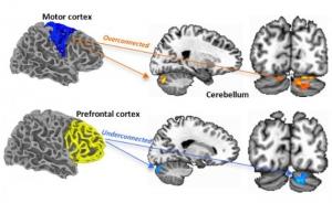 AUTISME: Quand le cortex sensori-moteur prend le pas sur la cognition – Biological Psychiatry