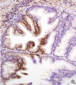 CANCER de la PROSTATE: Découverte d'un nouveau gène marqueur d'agressivité – Oncogène
