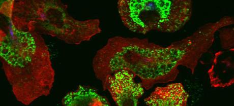 IMMUNOTHÉRAPIE CONTRE LE CANCER : LA RÉVOLUTION ATTENDUE IMMUNOTHÉRAPIE CONTRE LE CANCER : LA RÉVOLUTION ATTENDUE