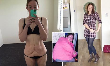 Les photos chocs d'une femme ayant perdu 100 kilos