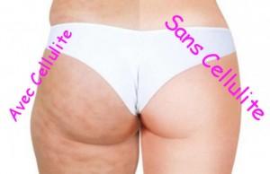 cellulite photo avec et sans celullite