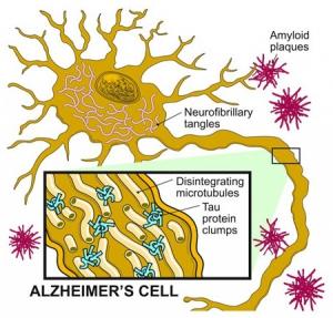 ALZHEIMER: Réduire le cholestérol du cerveau pour normaliser Tau – Inserm et Human Molecular Genetics