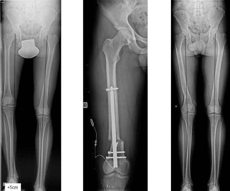 L’allongement osseux par dispositif implantable motorisé – CHU de TOULOUSE CHU_Toulouse