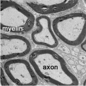 SCLÉROSE en plaques: Découverte d'une protéine clé de la myéline  – Nature Communications