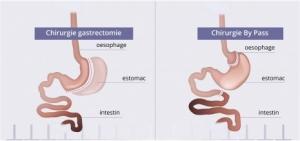 CHIRURGIE BARIATRIQUE: Elle s'attaque avant tout au glucose – Gastroenterology