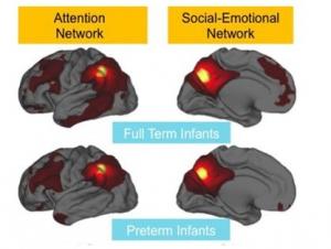 PRÉMATURITÉ: Ces connexions qui se font moins bien dans le cerveau – Meeting Neuroscience 2015 PRÉMATURITÉ: Ces connexions qui se font moins bien dans le cerveau – Meeting Neuroscience 2015