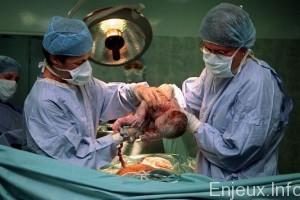 Algérie : Près du quart des accouchements se font par césarienne Algérie : Près du quart des accouchements se font par césarienne