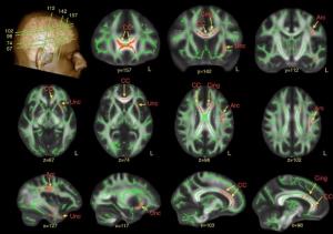 AUTISME: Des différences cérébrales subtiles identifiées chez les hommes atteints  – Brain