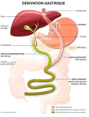 #thelancet #chirurgiebariatrique #altérationsmésentériques Réduction des altérations mésentériques en chirurgie de dérivation gastrique par laparoscopie #thelancet #chirurgiebariatrique #altérationsmésentériques Réduction des altérations mésentériques en chirurgie de dérivation gastrique par laparoscopie