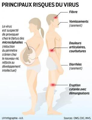 #thelancetinfectiousdiseases #zika #foetus #microcéphalie Détection et séquençage du virus Zika à partir du liquide amniotique de fœtus atteints de microcéphalie : une étude de cas #thelancetinfectiousdiseases #zika #foetus #microcéphalie Détection et séquençage du virus Zika à partir du liquide amniotique de fœtus atteints de microcéphalie : une étude de cas