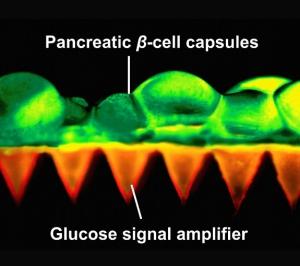 DIABÈTE: Un patch de bêta productrices d'insuline pour un contrôle glycémique sans douleur – Advanced Materials