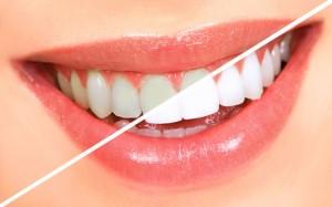 Bar à sourire  et blanchiment des dents : est-ce un bon plan?