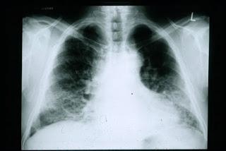 #thelancet #fibrosepulmonaireidiopathique #refluxgastrooesophagien #traitementantiacide #pirfenidone Traitement antiacide et évolution de la pathologie dans le cas de la fibrose pulmonaire idiopathique : analyse de données mutualisées