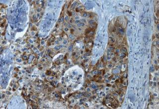 #thelancetoncology #CBNPC #dabrafenib #BRAFkinase #BRAFV600E  Dabrafenib chez des patients atteints de cancer du poumon non à petites cellules avancé BRAFV600E-positif : étude multicentrique de phase 2 à simple bras