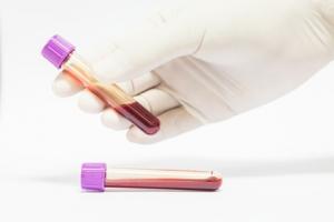 TRAUMA CÉRÉBRAL: L'évaluer par simple test sanguin  – JAMA