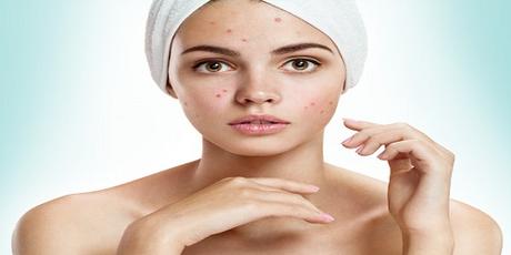 comment lutter contre l'acné