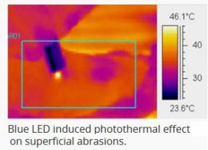 PLAIES SUPERFICIELLES: La LED bleue pour mieux photocoaguler  – Journal of Biophotonics