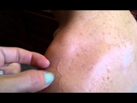 Peau qui pele bronzage : comment hydrater la peau ?