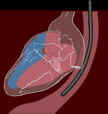 #thelancet #fibrillationauriculaire #cardioversion #edoxaban #enoxaparine-warfarine Edoxaban versus enoxaparine-warfarine chez des patients soumis à une cardioversion pour réduction de leur fibrillation auriculaire (ENSURE-AF) : essai randomisé, ouvert... #thelancet #fibrillationauriculaire #cardioversion #edoxaban #enoxaparine-warfarine Edoxaban versus enoxaparine-warfarine chez des patients soumis à une cardioversion pour réduction de leur fibrillation auriculaire (ENSURE-AF) : essai randomisé, ouvert...