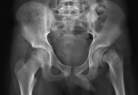 OBÉSITÉ: Les 6 complications sur l’os de l’enfant – Santé Orthopédique