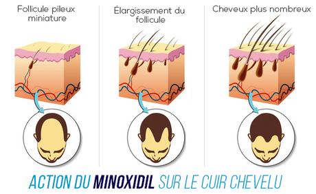 Comment lutter contre la chute capillaire chute capillaire