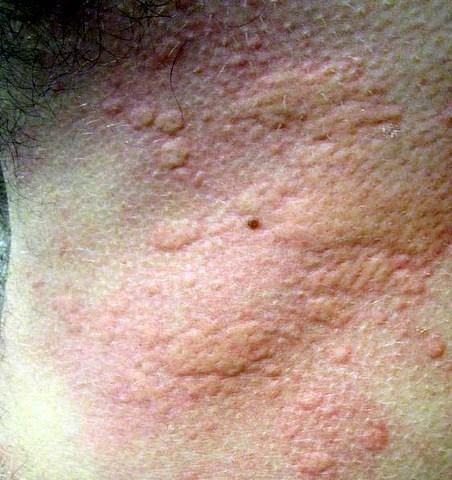 bronzage peau qui gratte bronzage peau qui gratte