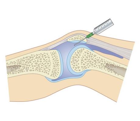 ARTHROSE du GENOU: L’efficacité de l’injection d’acide hyaluronique? – Santé Orthopédique gettyimages-141527436-56aaeabb5f9b58b7d009182d-696x605