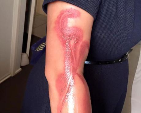 Une femme brûlée au 2e degré par son iPhone 7 brulure-2e-degre-iphone-7