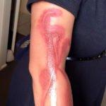 Une femme brûlée au 2e degré par son iPhone 7 brulure-2e-degre-iphone-7