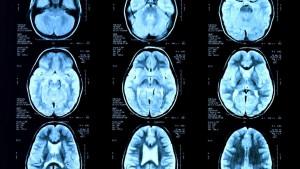 Le Curcuma contre les acouphènes épilepsie