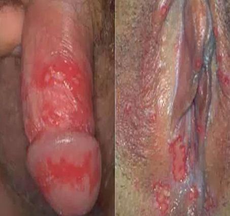 cara mengobati Herpes cara mengobati Herpes