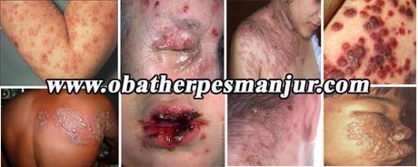 cara mengobati Herpes cara mengobati Herpes