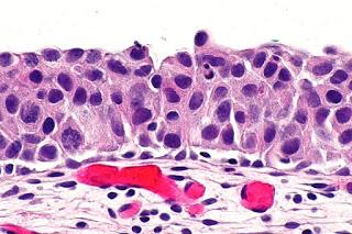 #thelancetoncology #cancerurothelial #PD-L1 #nivolumab Nivolumab pour traitement du carcinome urothélial métastatique après thérapie à base de platine (CheckMate 275) : étude multicentrique de phase 2 à simple bras