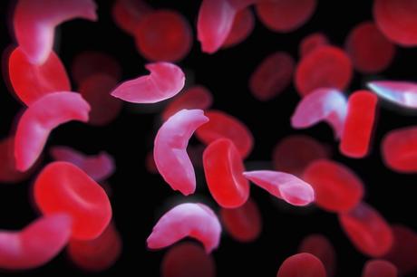 Drépanocytose : première guérison par thérapie génique Drépanocytose : première guérison par thérapie génique