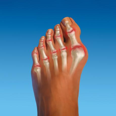 arthrite arthrite