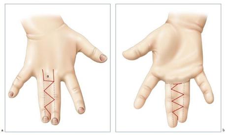 Syndactylie des doigts Syndactylie des doigts