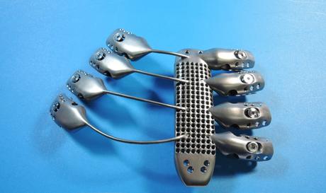 NFI crée un implant en titane pour le sternum NFI crée un implant en titane pour le sternum