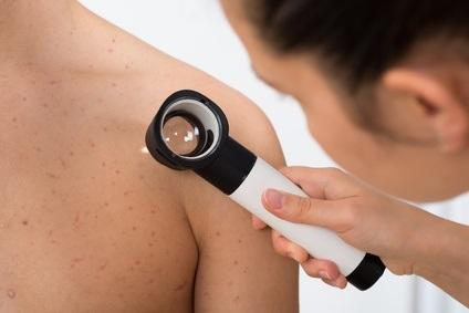 MÉLANOME : Pourquoi le vitiligo améliore le pronostic – Science Immunology