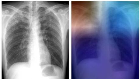TUBERCULOSE : L'intelligence artificielle pour la diagnostiquer  – Radiology