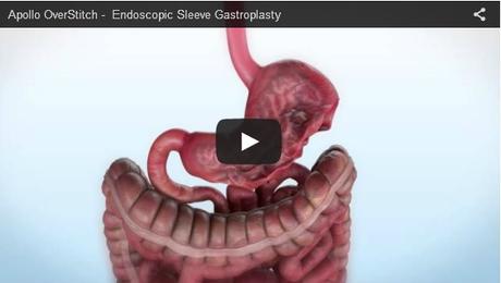OBÉSITÉ : La gastroplastie non chirurgicale montre son efficacité – Digestive Disease Week