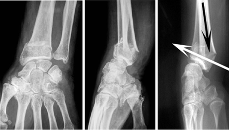 Les fractures du poignet chez l’adulte : traitement et complications