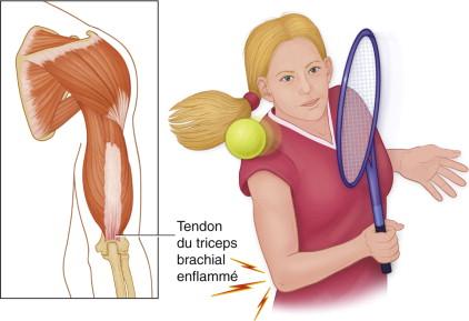 Tendinite du triceps brachial : causes, symptômes et traitement