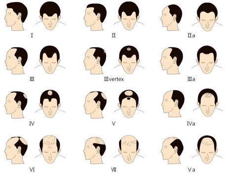Alopécie, toutes les causes et les symptômes de la calvitie masculine Alopécie, toutes les causes et les symptômes de la calvitie masculine