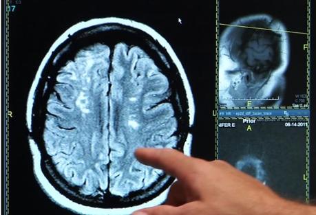 MÉMOIRE : La rétablir en cas de lésions cérébrales et d'AVC