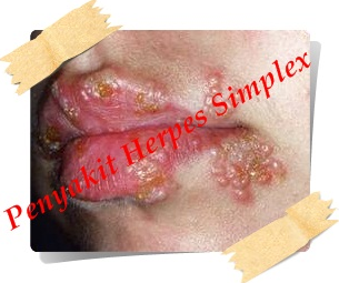 obat herpes salep