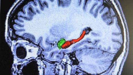 IRM ou l'on distingue l'hippocampe en 3D dans le cerveau d'un patient atteint de la maladie d'Alzheimer.