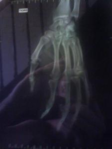 My broken hand